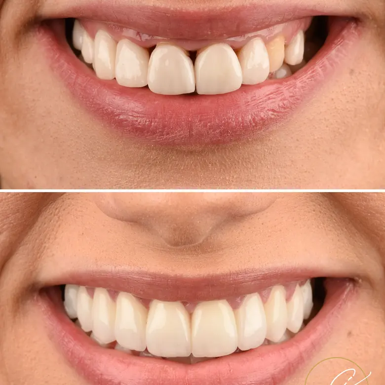 Caso clínico antes e depois — Facetas dentárias