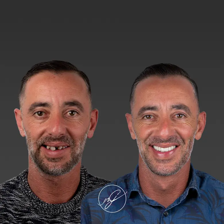 Caso clínico antes e depois — Implantes dentários