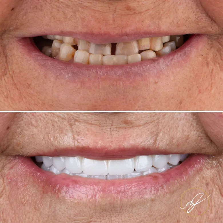 Caso clínico antes e depois — Implantes dentários