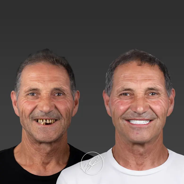 Caso clínico antes e depois — Implantes dentários